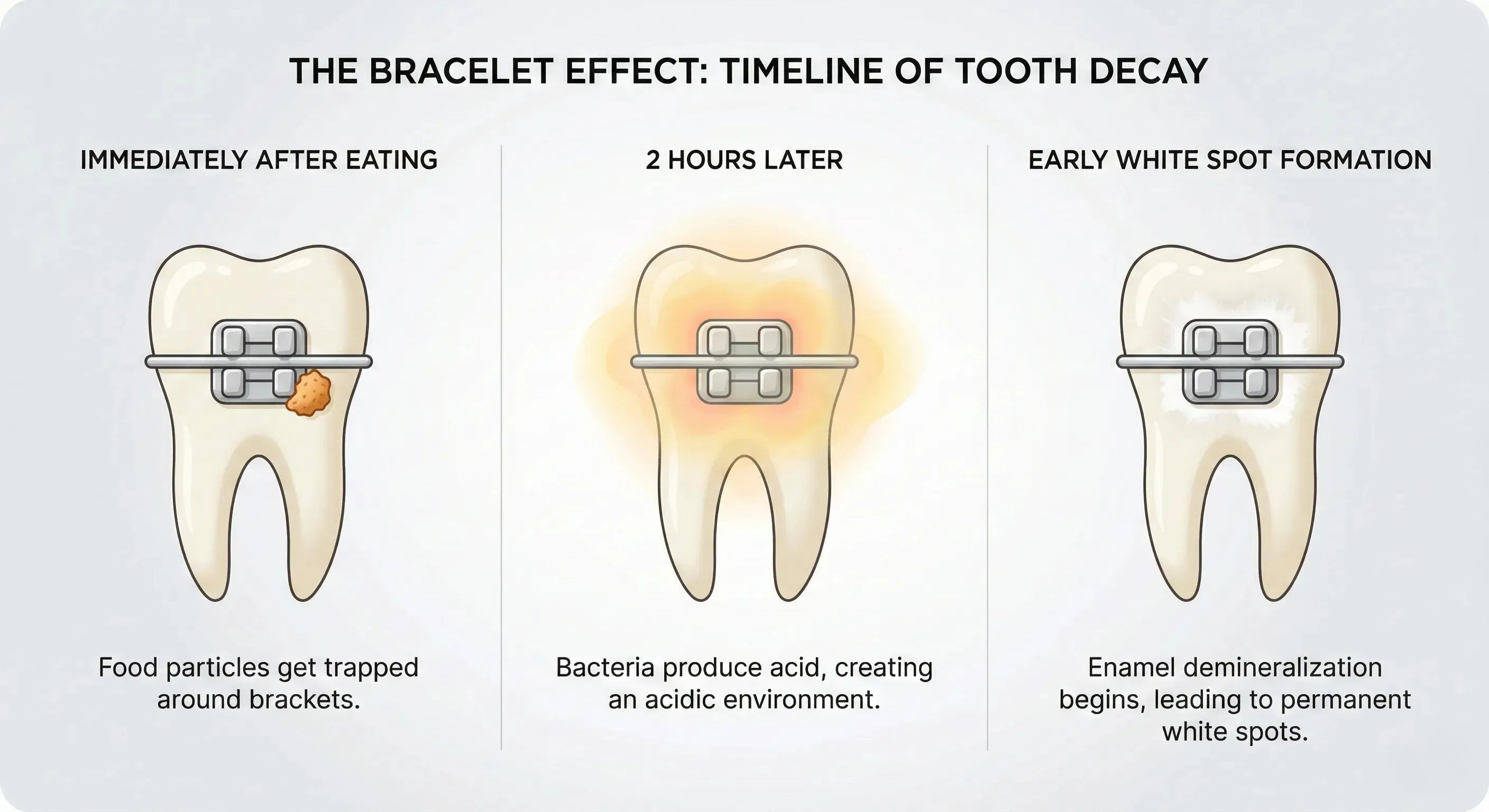 Bracelet effect timeline of tooth decay